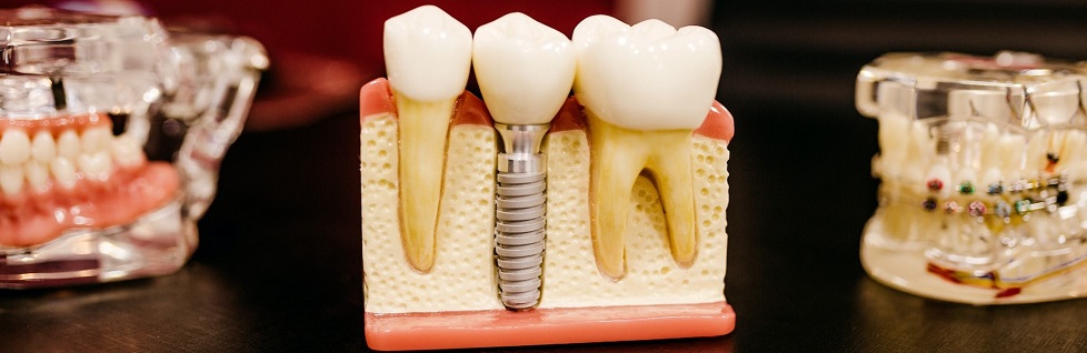 Prednosti zobnih implantatov