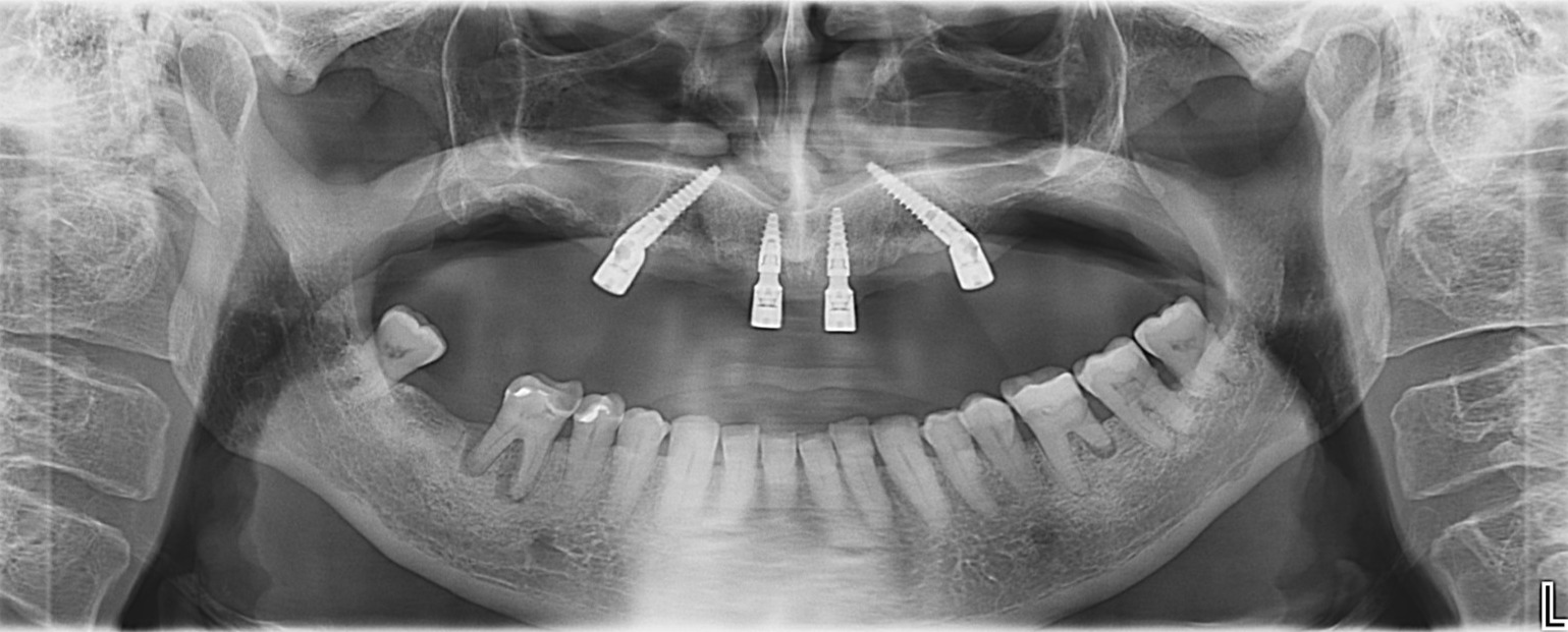  ALL-on_4 fiksni zobje v 24ih urah