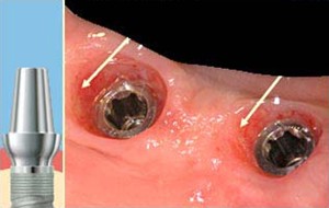 Postopek vstavljanja zobnega implantata