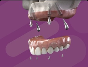 NeoArch® Proteza na implantatih
