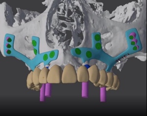 subperiostalni zobni implantati