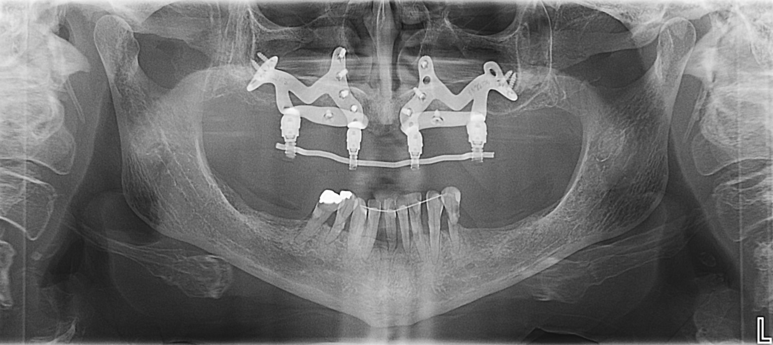 Subperiostalni zobni implanatati 