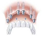 implantati za brezzobe čeljusti